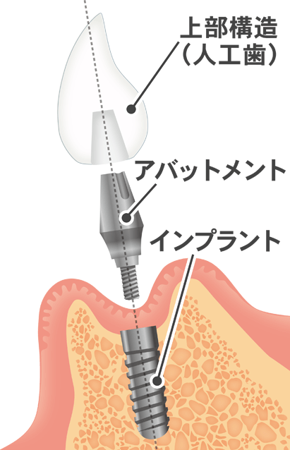 インプラント治療