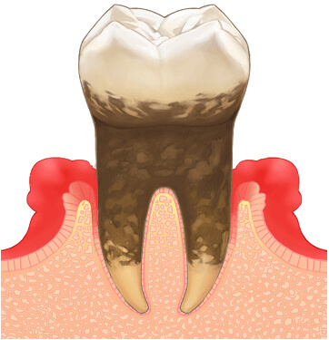 歯周病（中度）