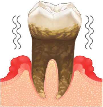 歯周病進行の検査