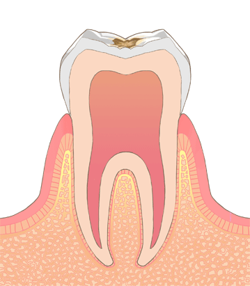 歯の図１