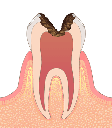 歯の図３