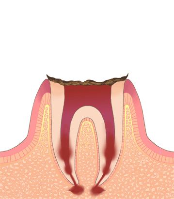 歯の図４