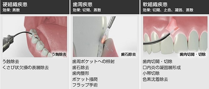 エルビウムヤグレーザー