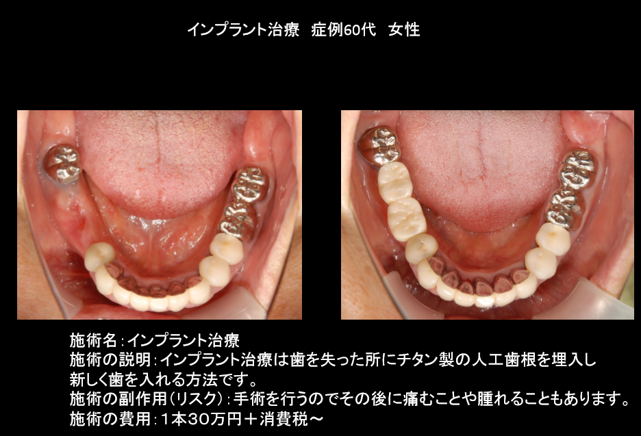 インプラント　60代