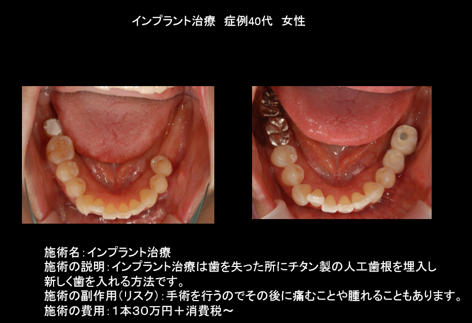 インプラント　40代