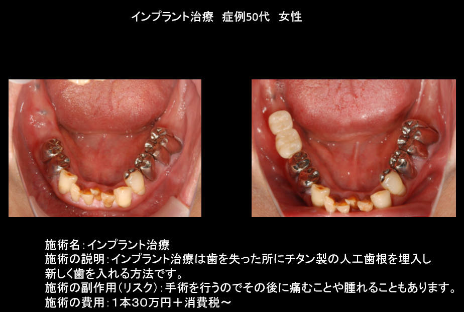 インプラント　50代