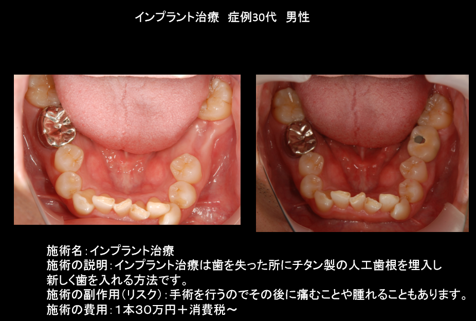 インプラント　30代