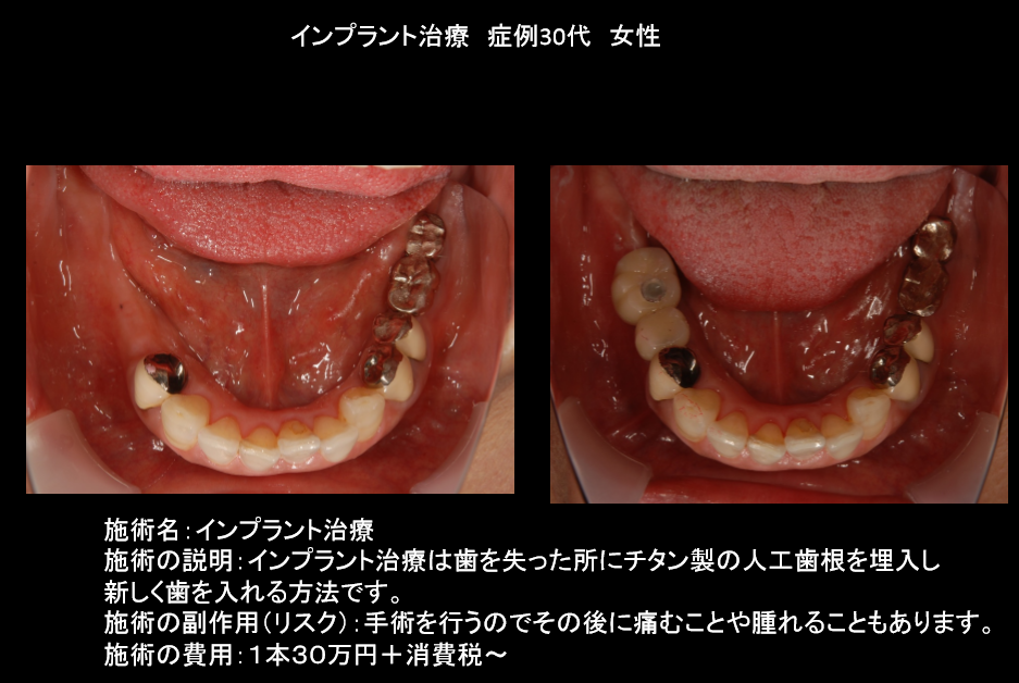 インプラント　30代女性