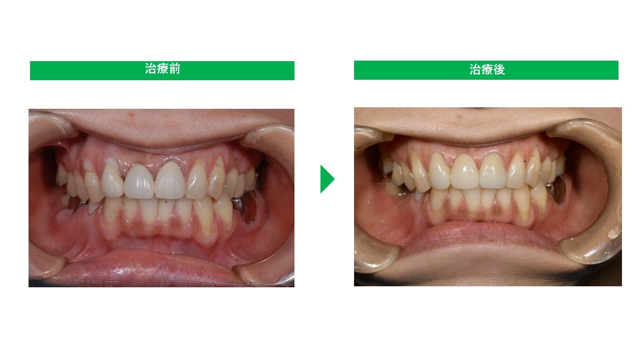 emax