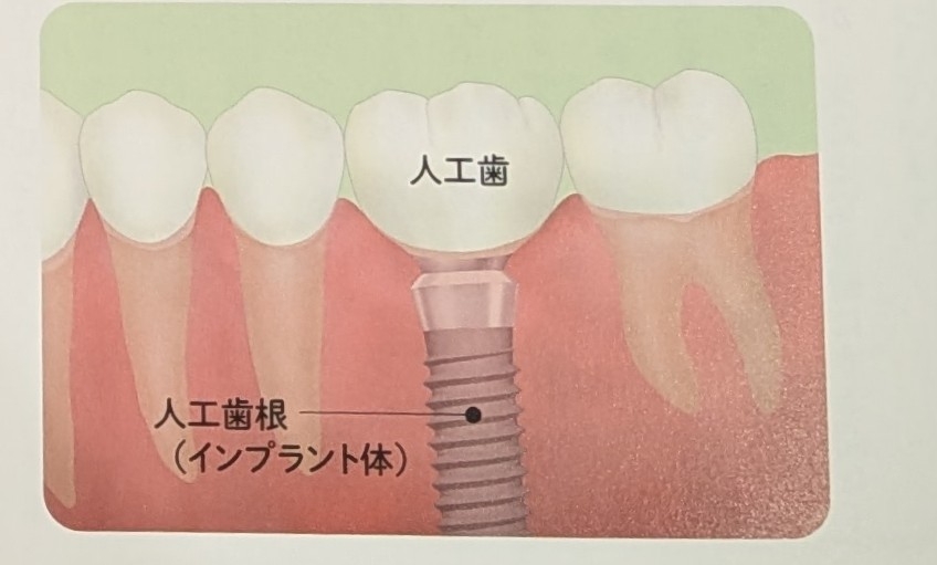 インプラント治療