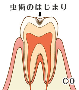 虫歯の進行度と症状