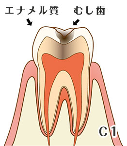 虫歯の進行度と症状