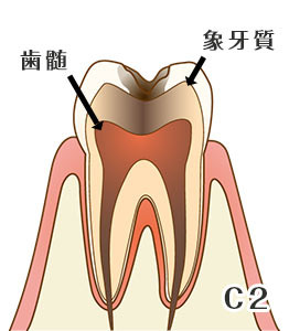虫歯の進行度と症状
