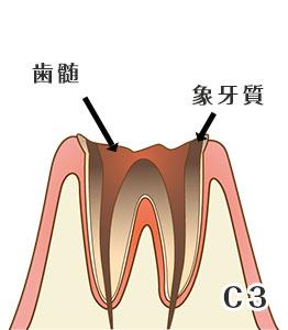 虫歯の進行度と症状
