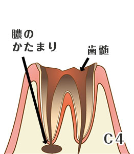 虫歯の進行度と症状